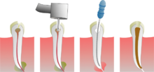 220px-Root_Canal_Illustration